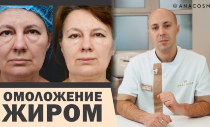 НАНОЛІПОФІЛІНГ VS ЛІПОФІЛІНГ ОБЛИЧЧЯ: ОМОЛОДЖЕННЯ ЖИРОМ 💉🔥 ЩО КРАЩЕ?