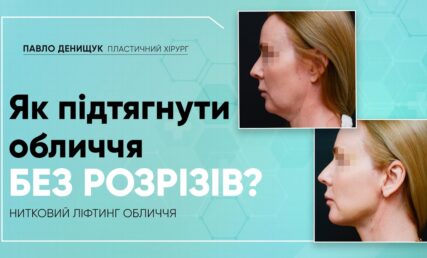 ПІДТЯЖКА ОБЛИЧЧЯ НИТКАМИ | НИТКОВИЙ ЛІФТИНГ ОБЛИЧЧЯ | ЛІГАТУРНИЙ ЛІФТИНГ