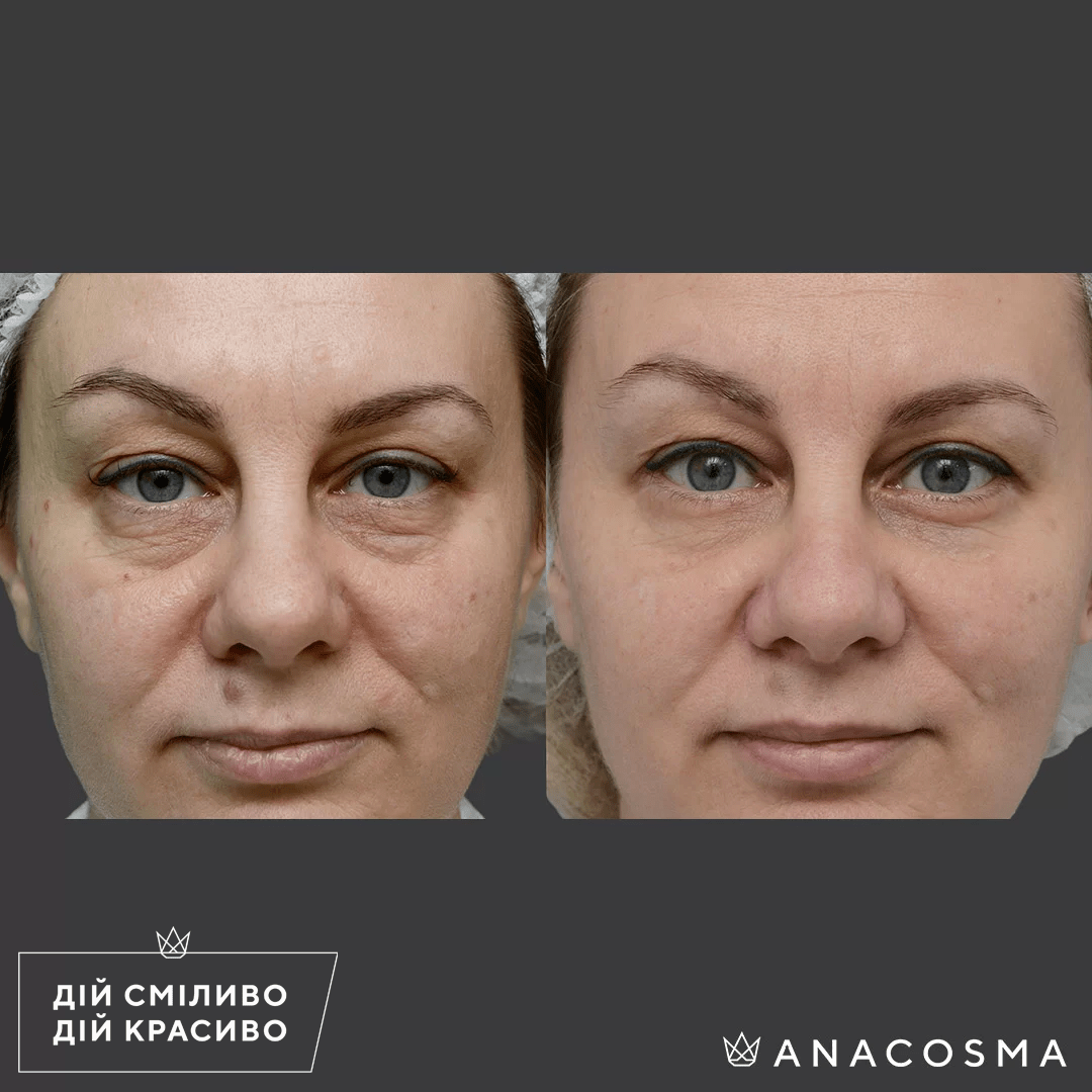 Blepharoplasty before and after - Photo 26