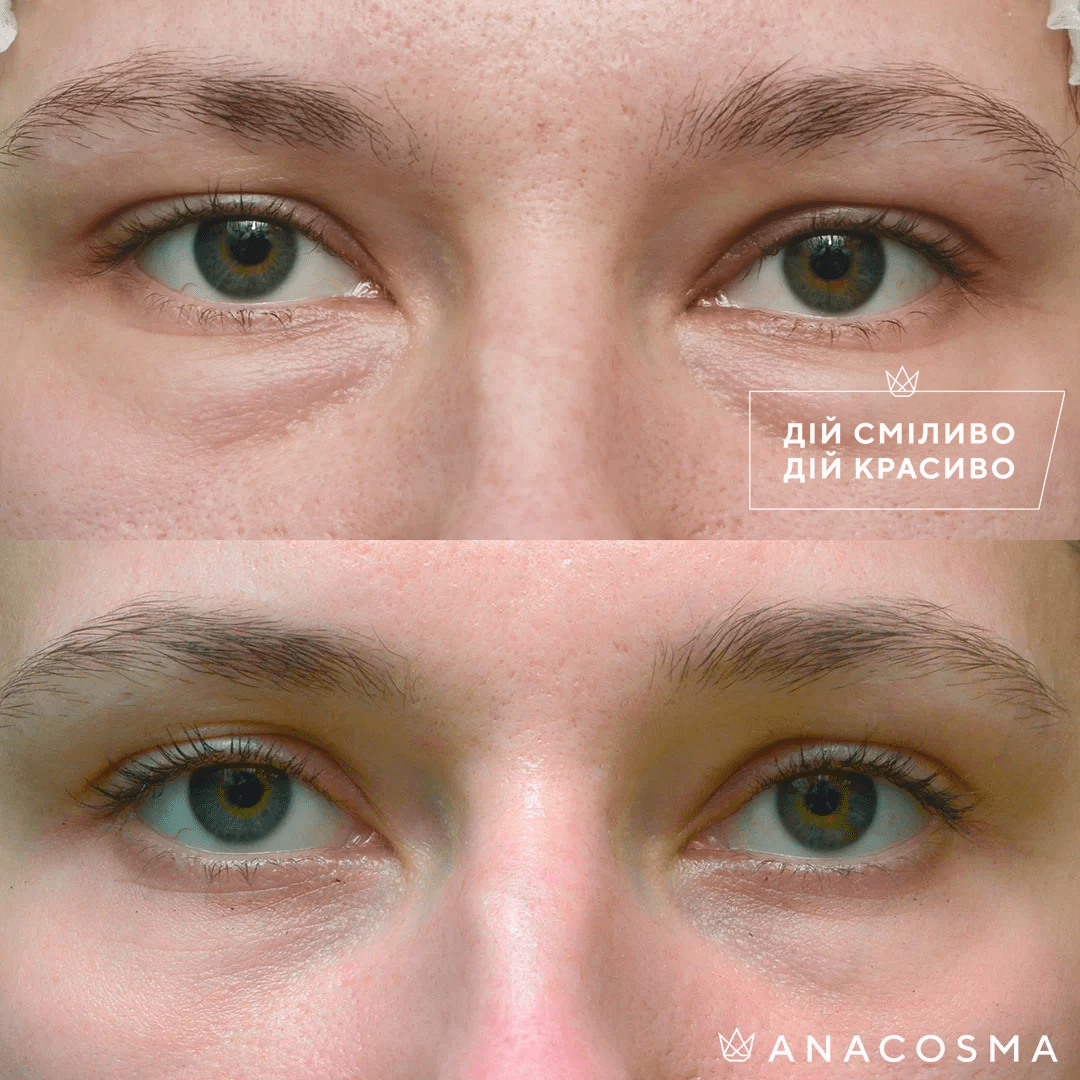 Blepharoplasty before and after - Photo 25