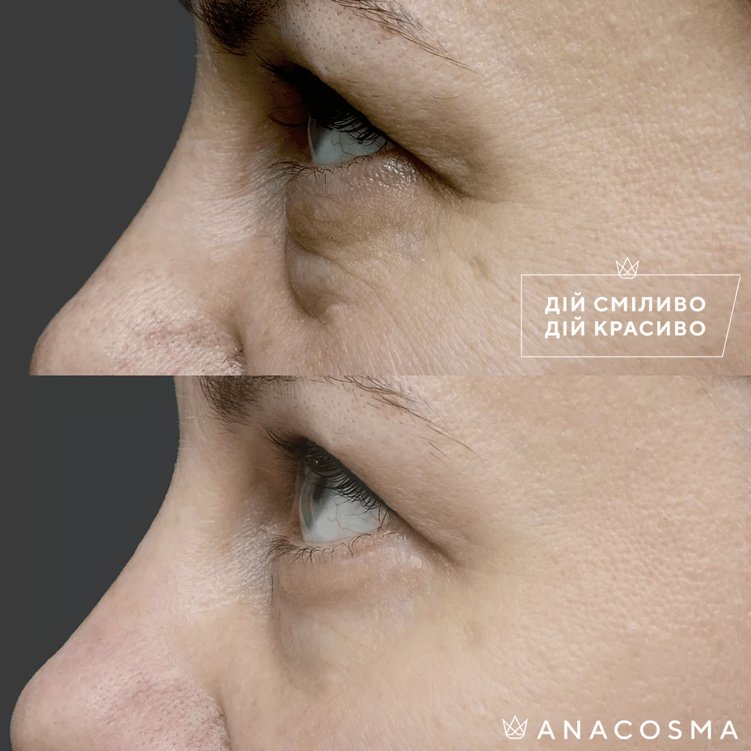 Blepharoplasty before and after - Photo 24