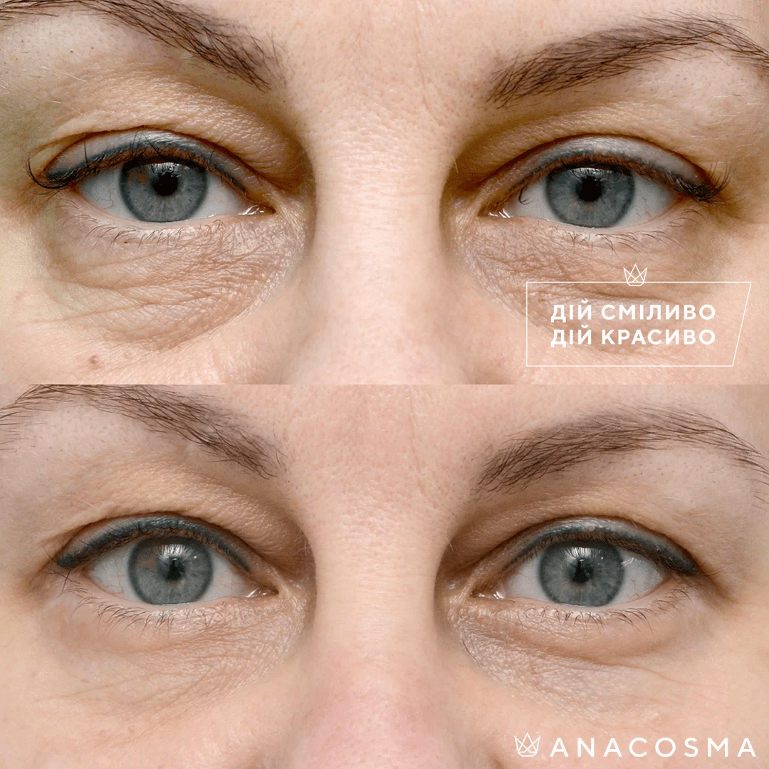 Blepharoplasty before and after - Photo 23