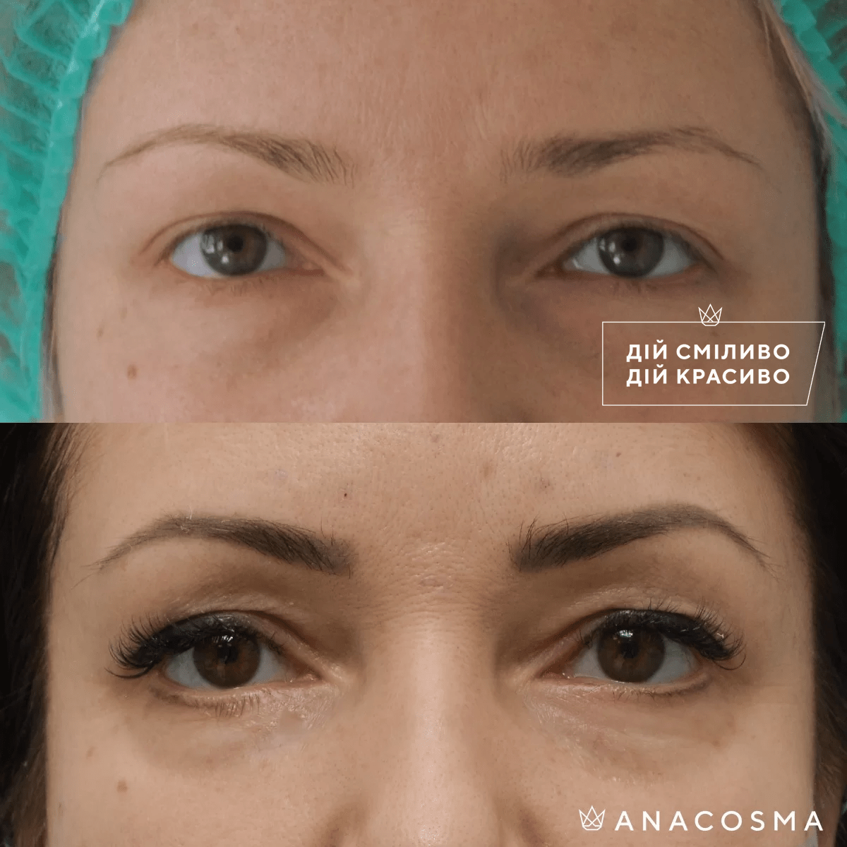 Blepharoplasty before and after - Photo 22