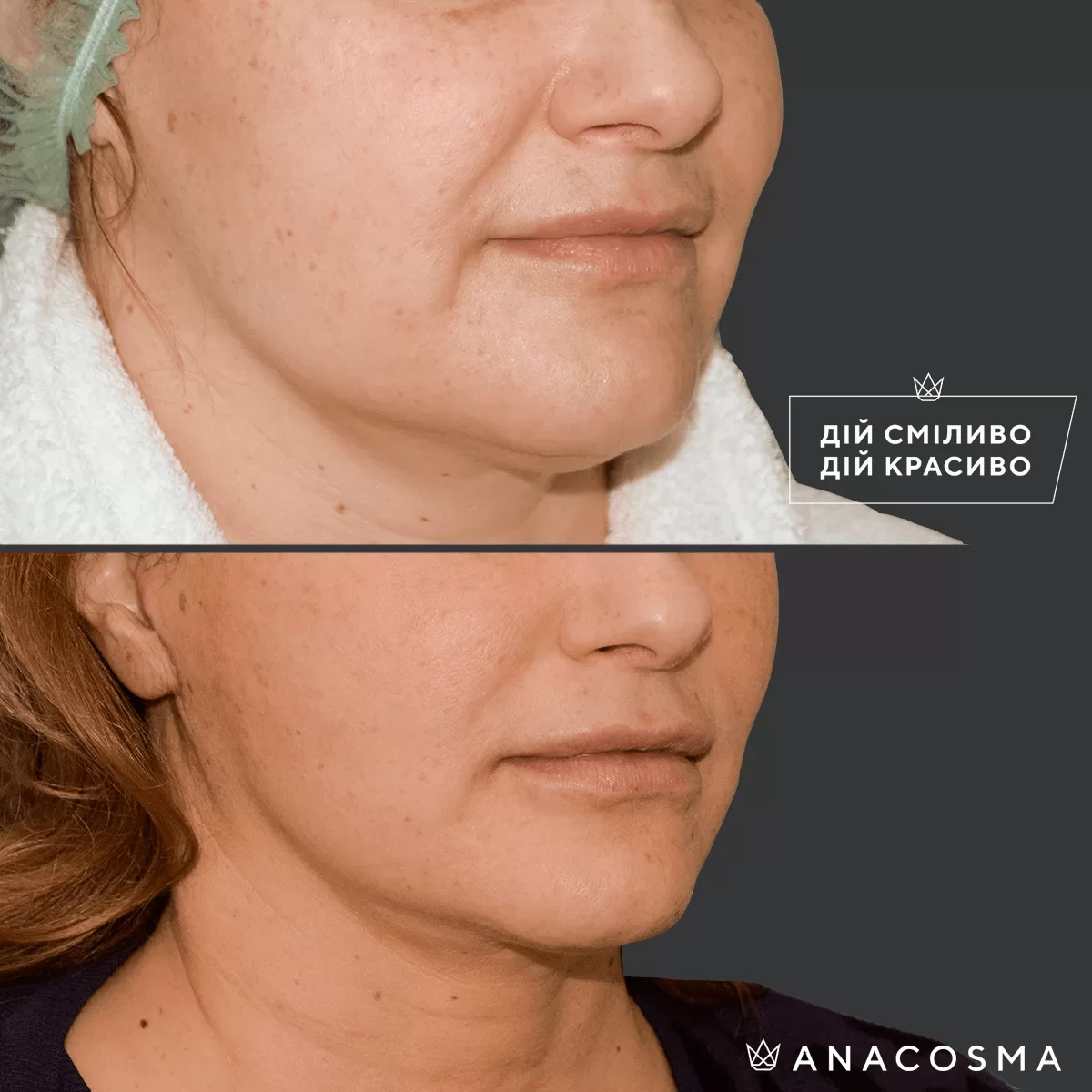 Facelift (thredlifting) before and after - Photo 25