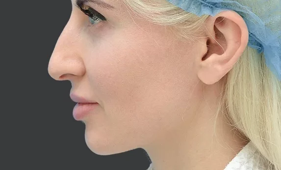 Nose Plastic Surgery - Photo before