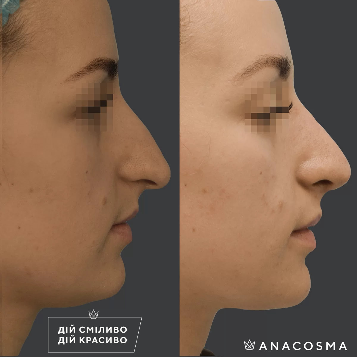 Nose Plastic Surgery before and after - Photo 29