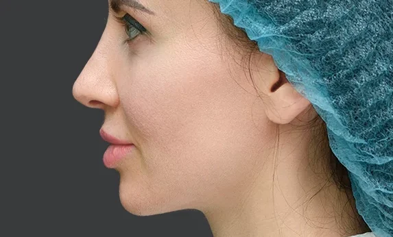 Nose Plastic Surgery - Photo after