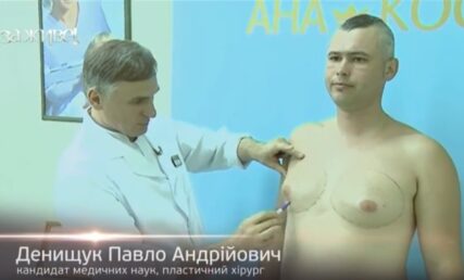 Телеканал СТБ, "За Живе" про гінекомастію у чоловіків. Як проходить операція і як виглядають груди після операції? Оперує Павло Денищук, канд. мед. наук, завідувач відділенням пластичної хірургії клініки ANACOSMA