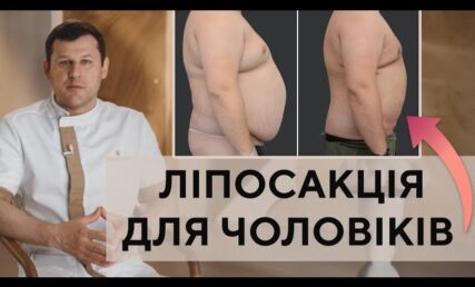 ЛІПОСАКЦІЯ ДЛЯ ЧОЛОВІКІВ - РЕЗУЛЬТАТИ, ОСОБЛИВОСТІ