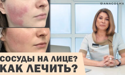 СОСУДЫ НА ЛИЦЕ: КУПЕРОЗ, РОЗАЦЕА ИЛИ ГЕМАНГИОМА 😱⛔️ КАК ЛЕЧИТЬ⁉️