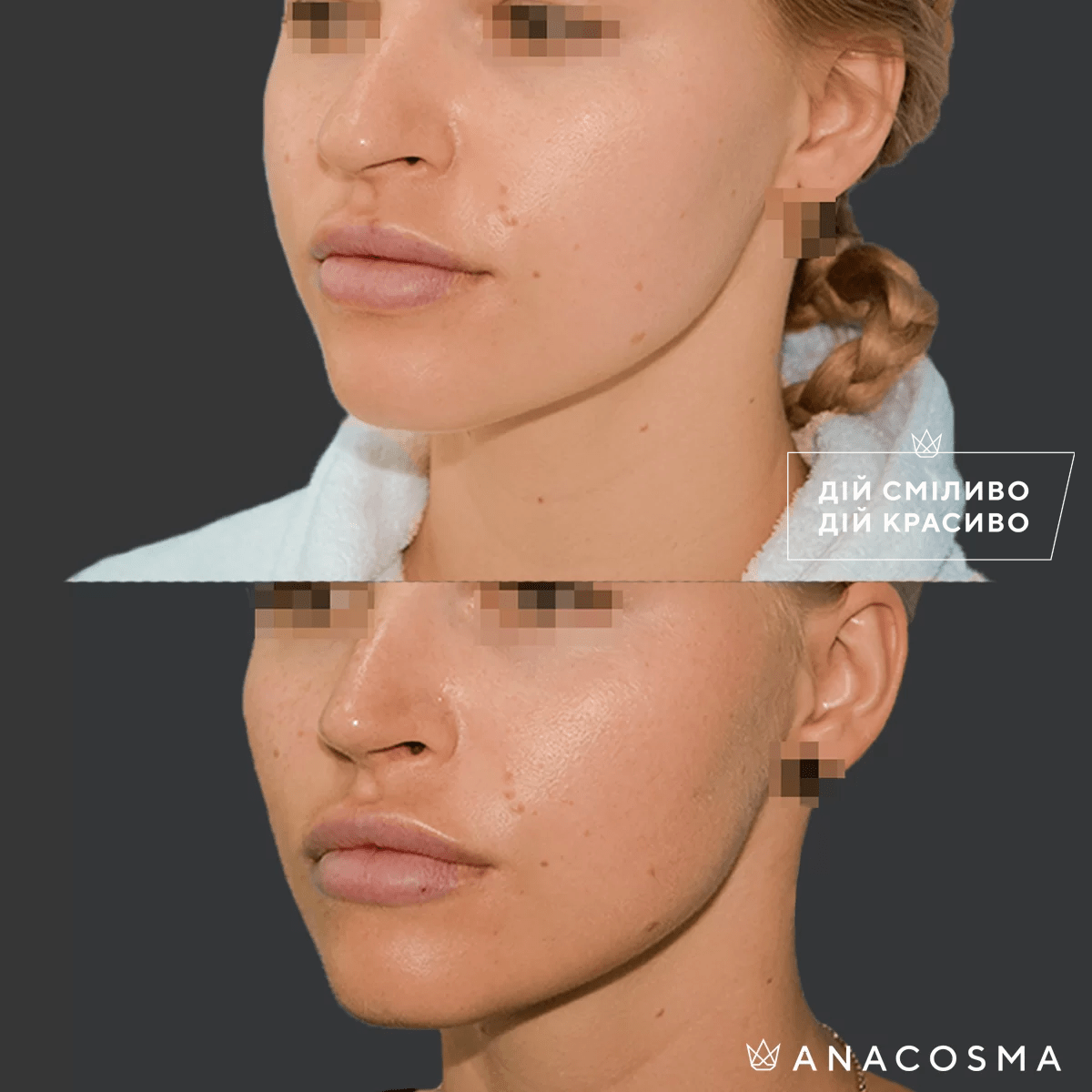 Buccal Fat Pad Removal before and after - Photo 1