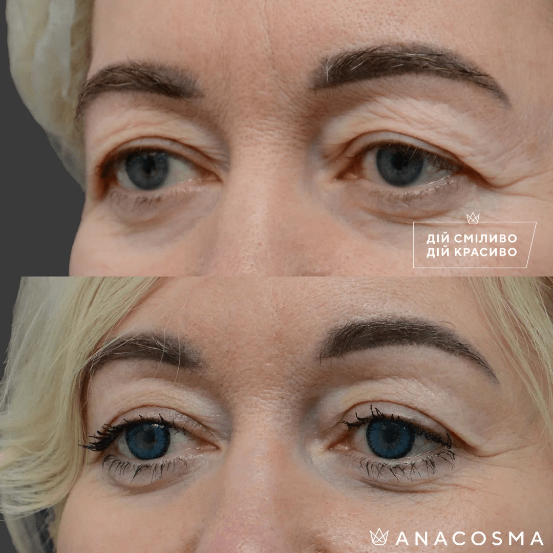 Blepharoplasty before and after - Photo 18