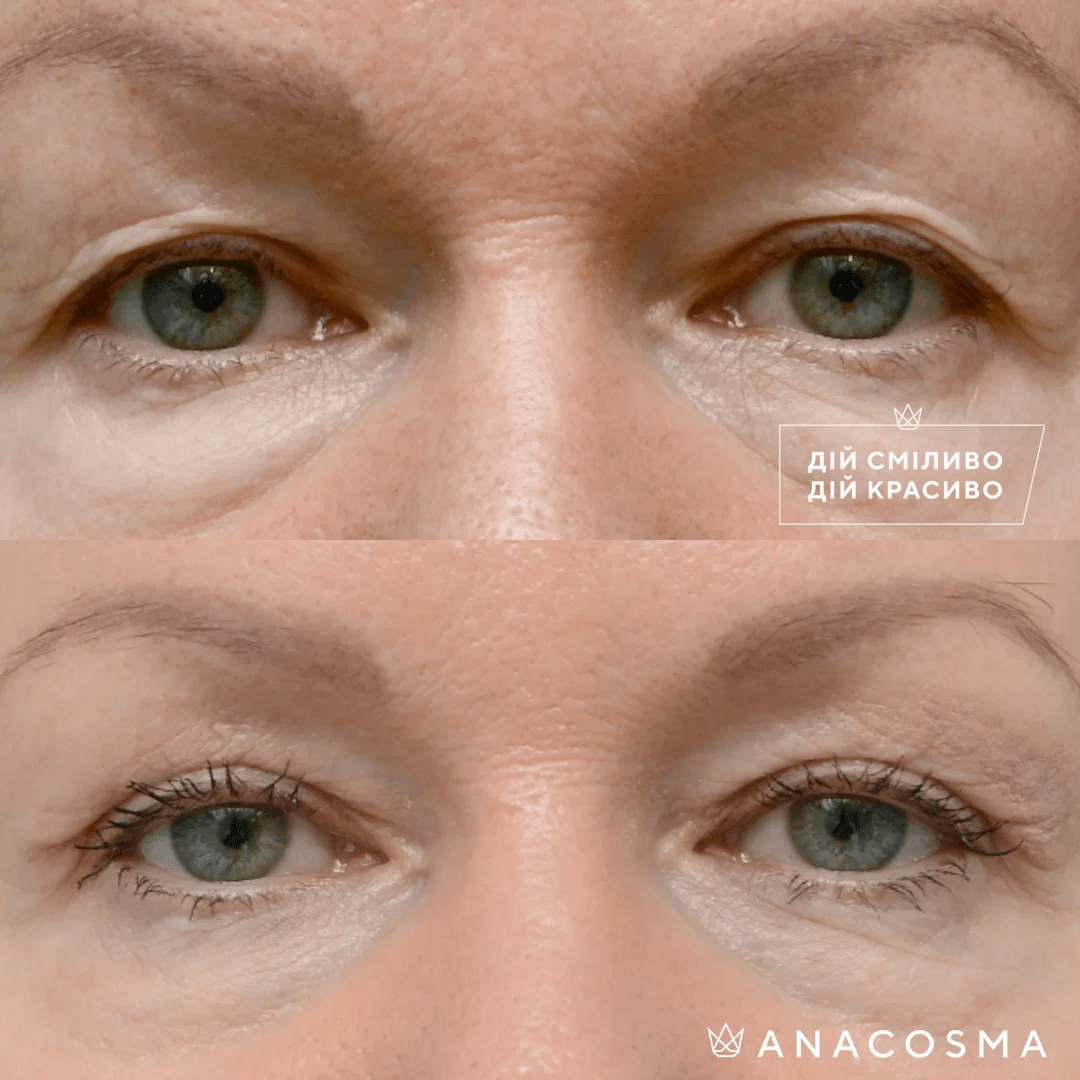 Blepharoplasty before and after - Photo 17