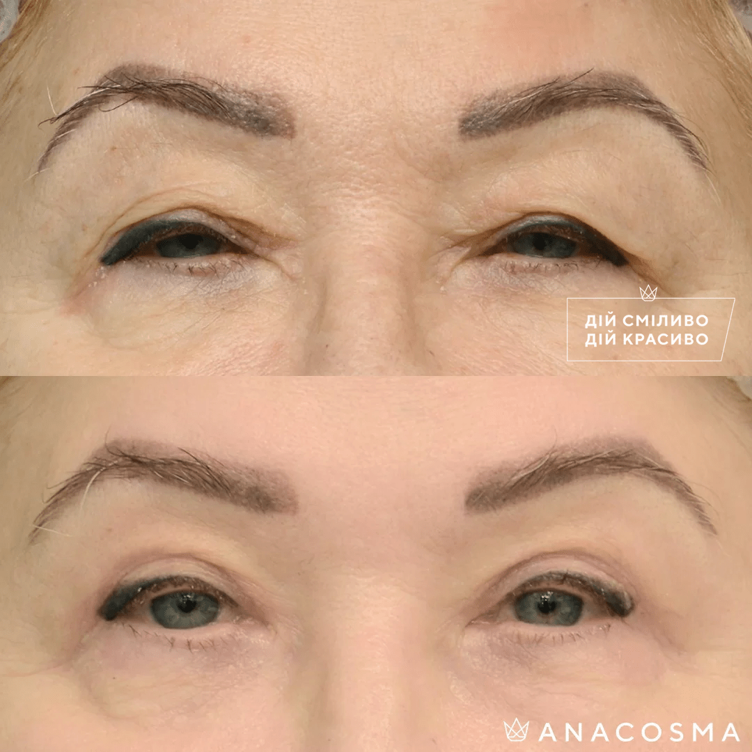Blepharoplasty before and after - Photo 15
