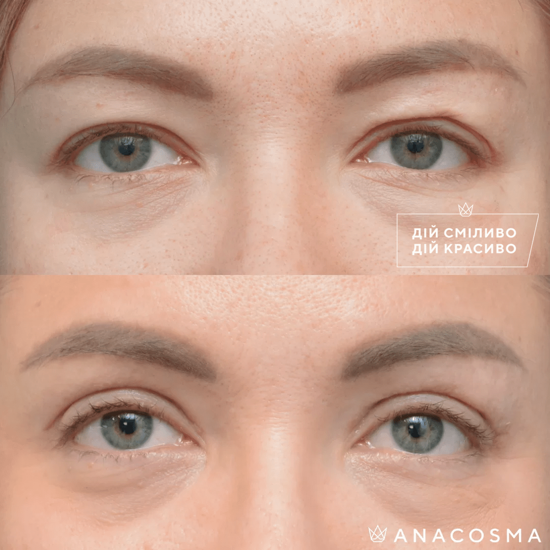 Blepharoplasty before and after - Photo 16