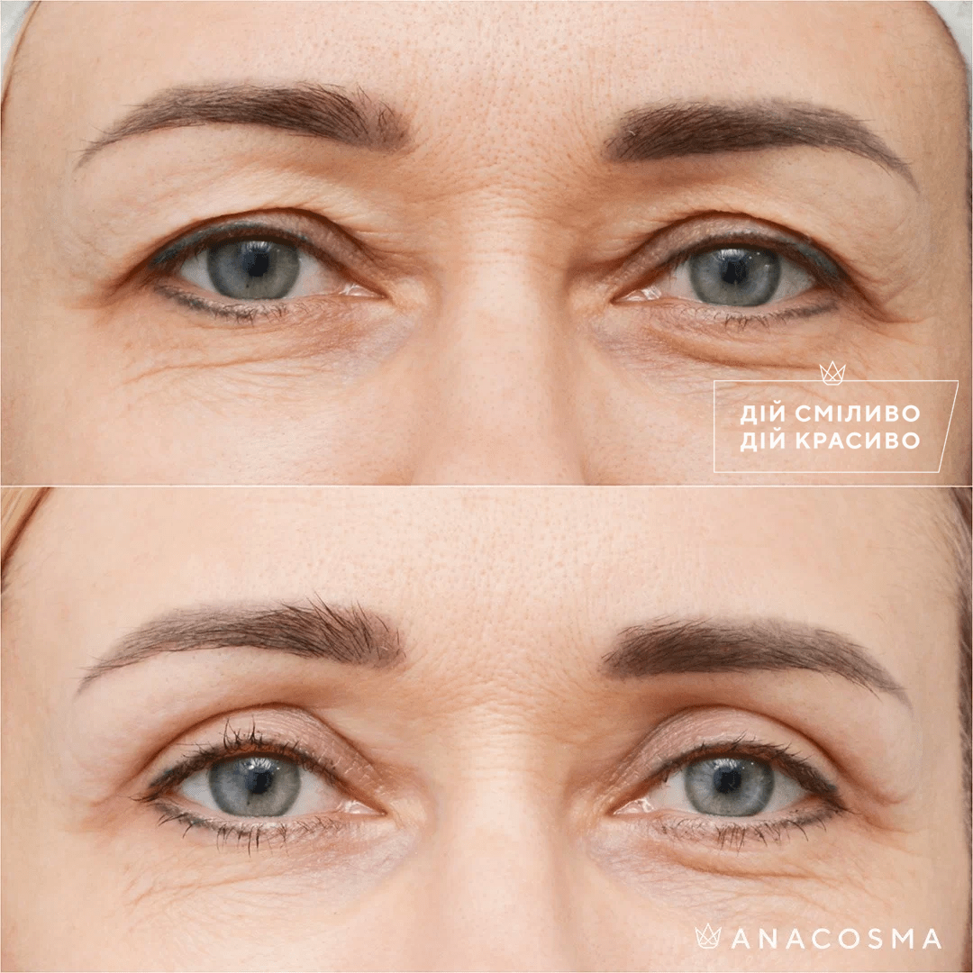 Blepharoplasty before and after - Photo 14