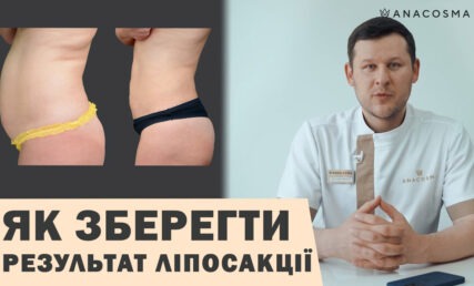 Ліпосакція ⛔ ДО СХУДНЕННЯ АБО ПІСЛЯ? ⚡