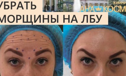 Як прибрати зморшки на лобі і між бровами