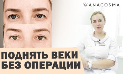Як підняти повіки БЕЗ ОПЕРАЦІЇ