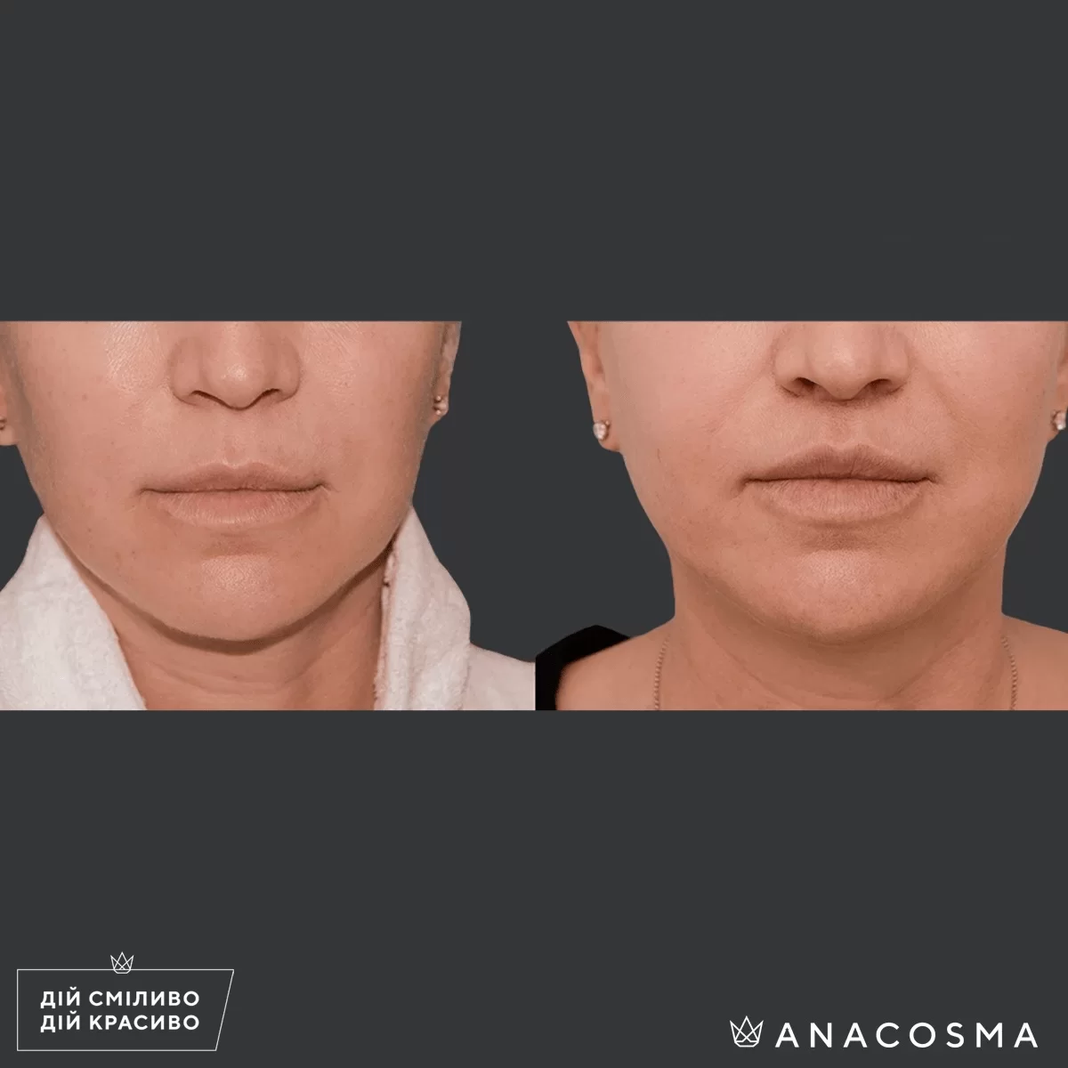 Bullhorn lip lift before and after - Photo 1