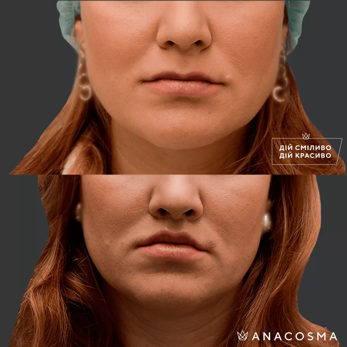 Bullhorn lip lift before and after - Photo 2
