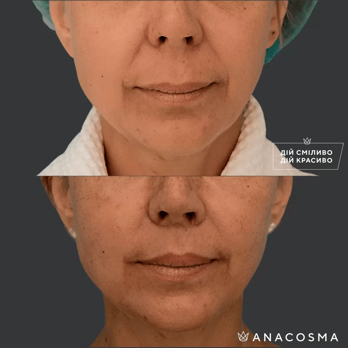 Bullhorn lip lift before and after - Photo 3