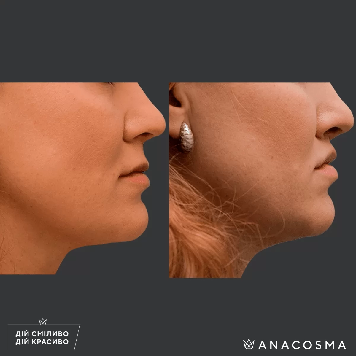 Bullhorn lip lift before and after - Photo 4