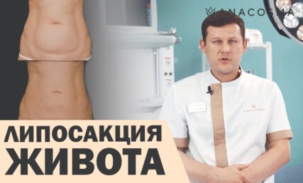 ЛІПОСАКЦІЯ ЖИВОТА 🔥ВІБРАЦІЙНА АБО УЛЬТРАЗВУКОВА ЛІПОСАКЦІЯ❓