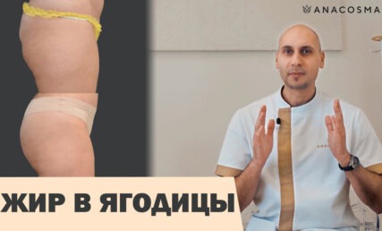 ЛИПОФИЛИНГ ЯГОДИЦ 🍑 ВАЖНО ЗНАТЬ 🔥 УВЕЛИЧЕНИЕ ЯГОДИЦ ЖИРОМ