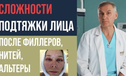 КРУГОВАЯ ПОДТЯЖКА ЛИЦА 🤕 СМАС ПОДТЯЖКА ПОСЛЕ ФИЛЛЕРОВ, НИТЕЙ, АЛЬТЕРЫ?