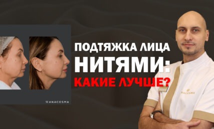 ПОДТЯЖКА ЛИЦА НИТЯМИ🧐 ЛИГАТУРНЫЙ ЛИФТИНГ VS МЕЗОНИТИ⚡️ КАКИЕ НИТИ ЛУЧШЕ ⁉️