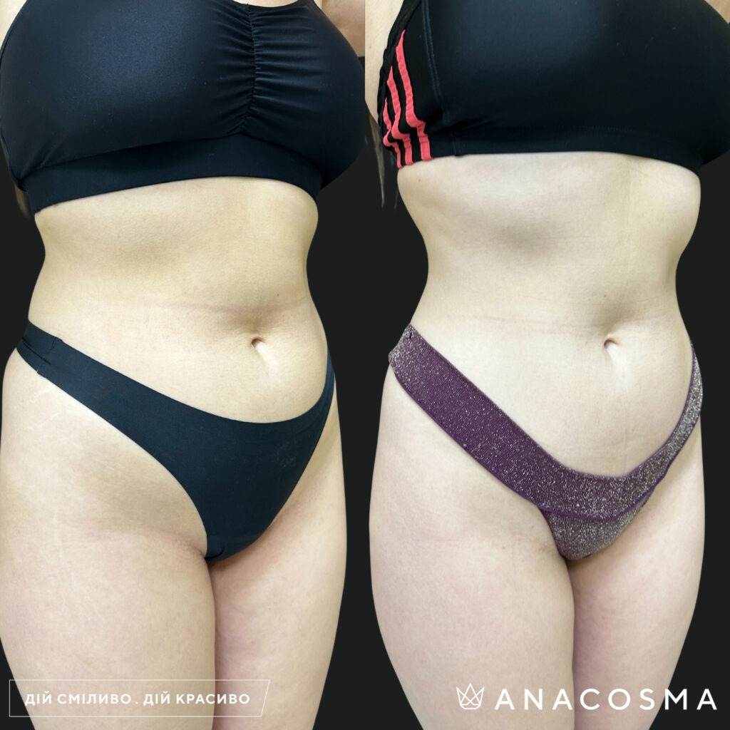 Скульптування тіла truSculpt flex до і після - Фото 3