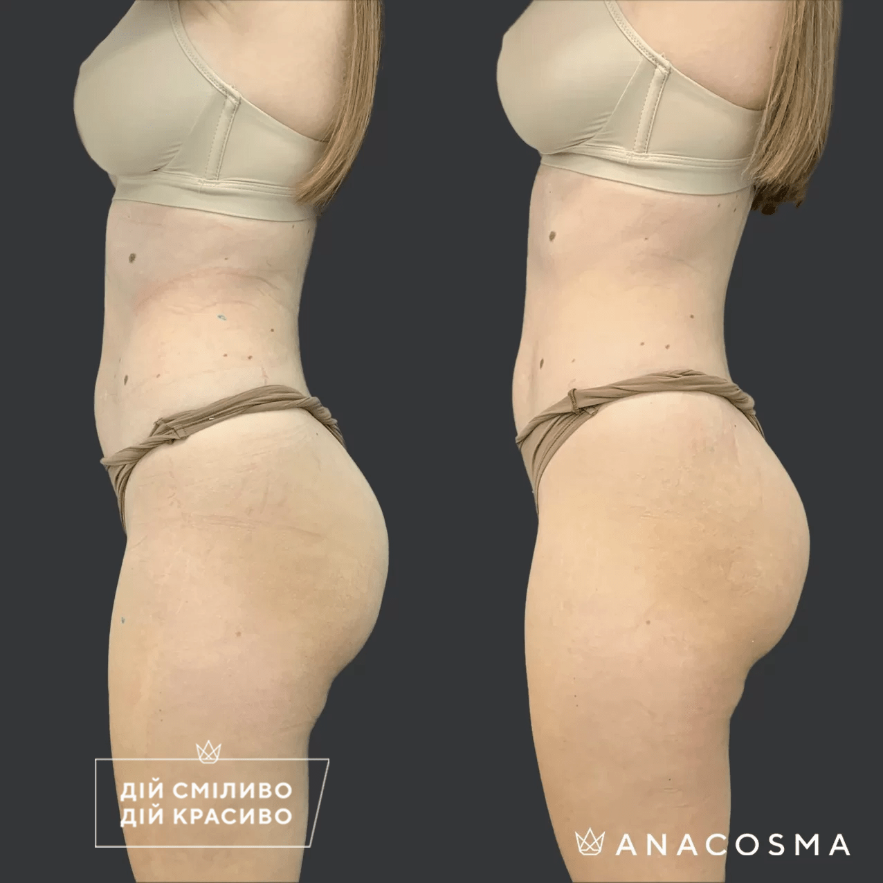 Скульптування тіла truSculpt flex до і після - Фото 10
