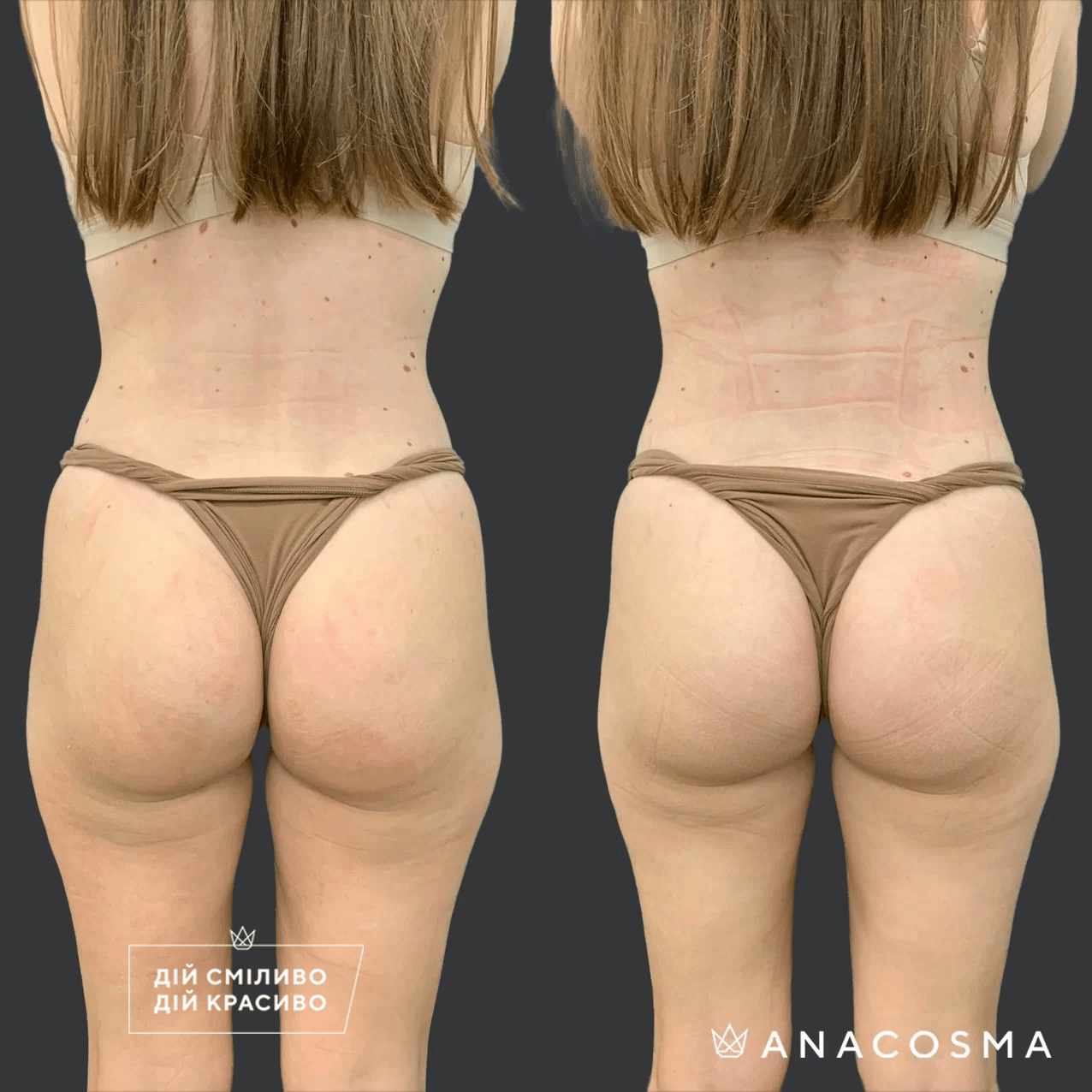 Скульптування тіла truSculpt flex до і після - Фото 8