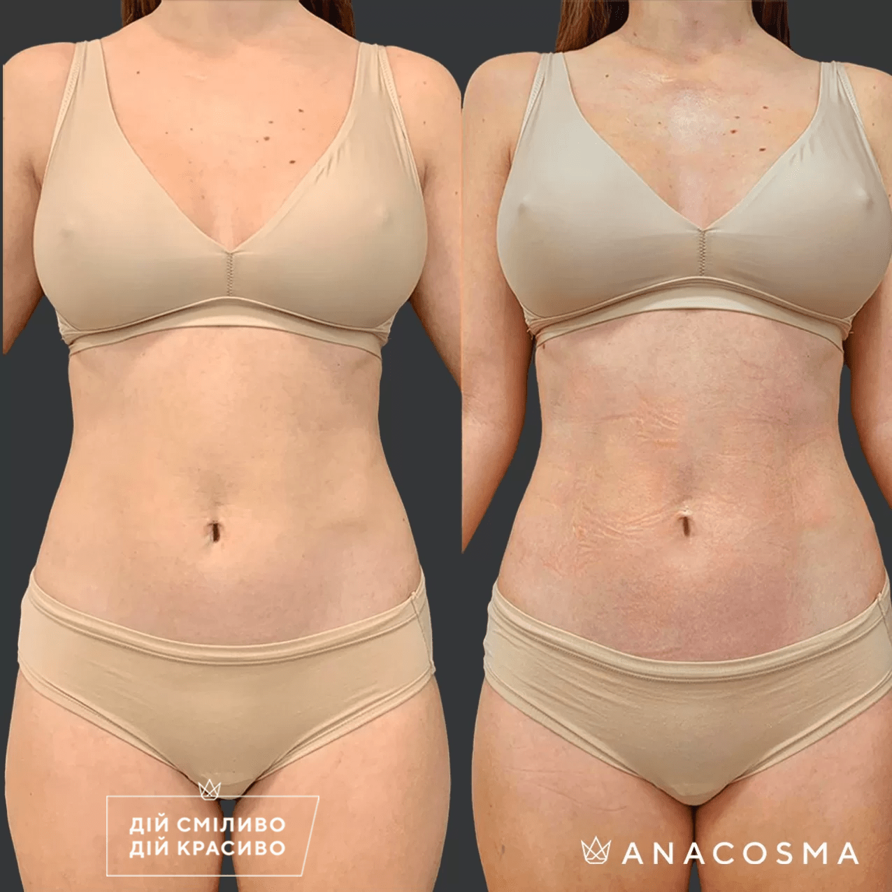 Скульптування тіла truSculpt flex до і після - Фото 11