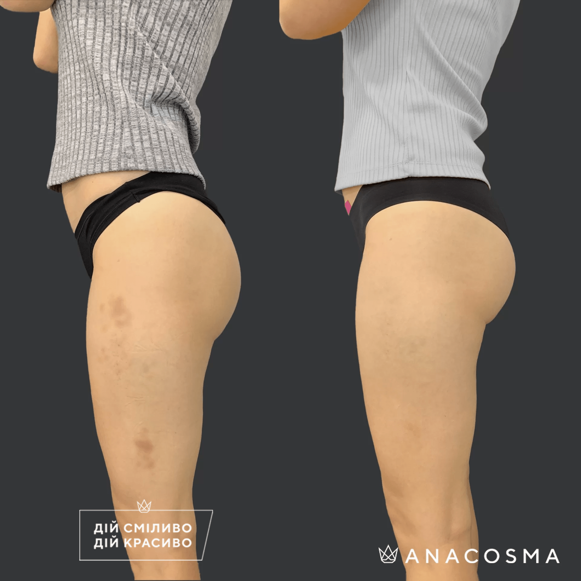 Скульптування тіла truSculpt flex до і після - Фото 13