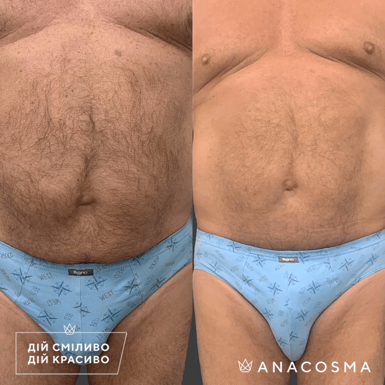 Скульптування тіла truSculpt flex до і після - Фото 16