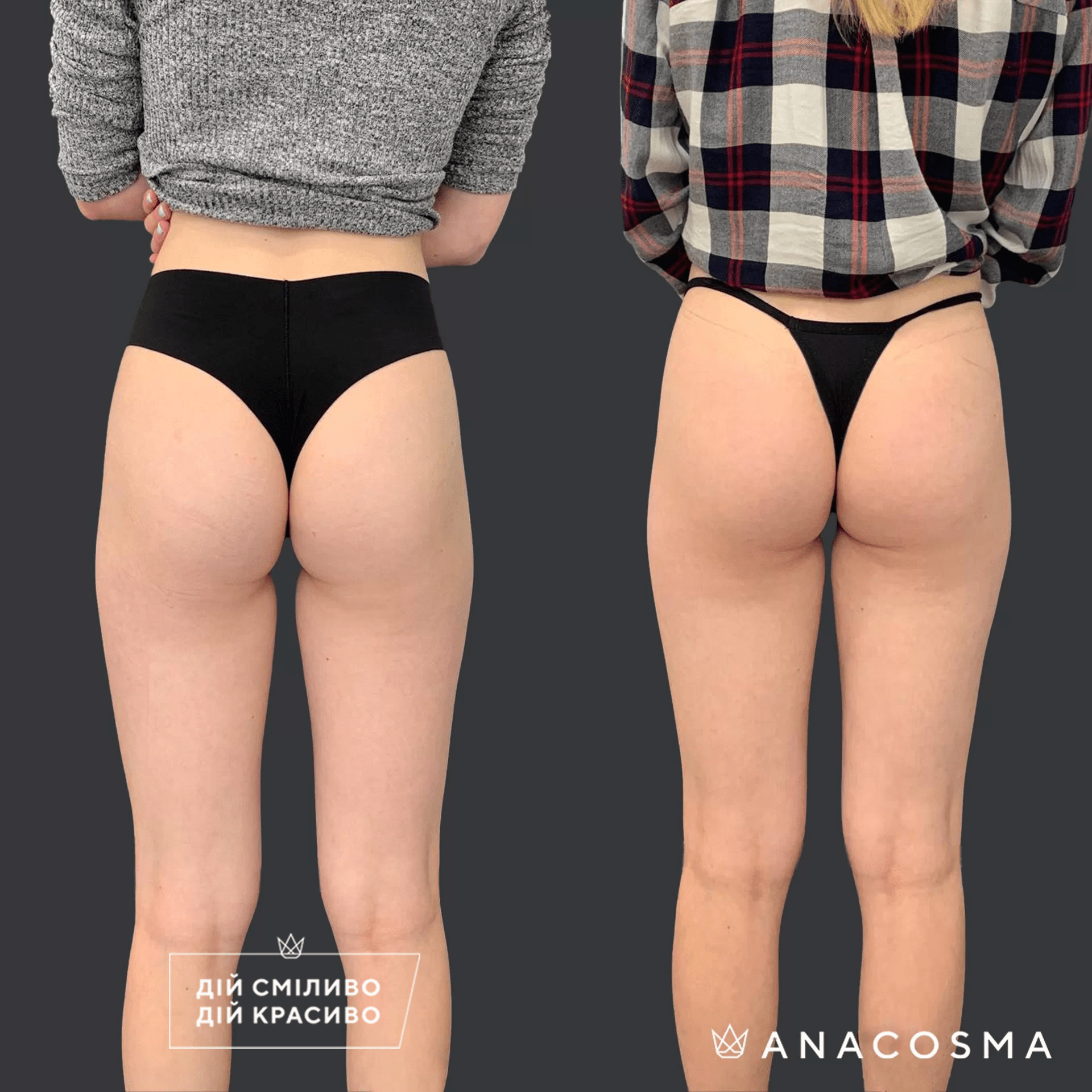 Скульптування тіла truSculpt flex до і після - Фото 19