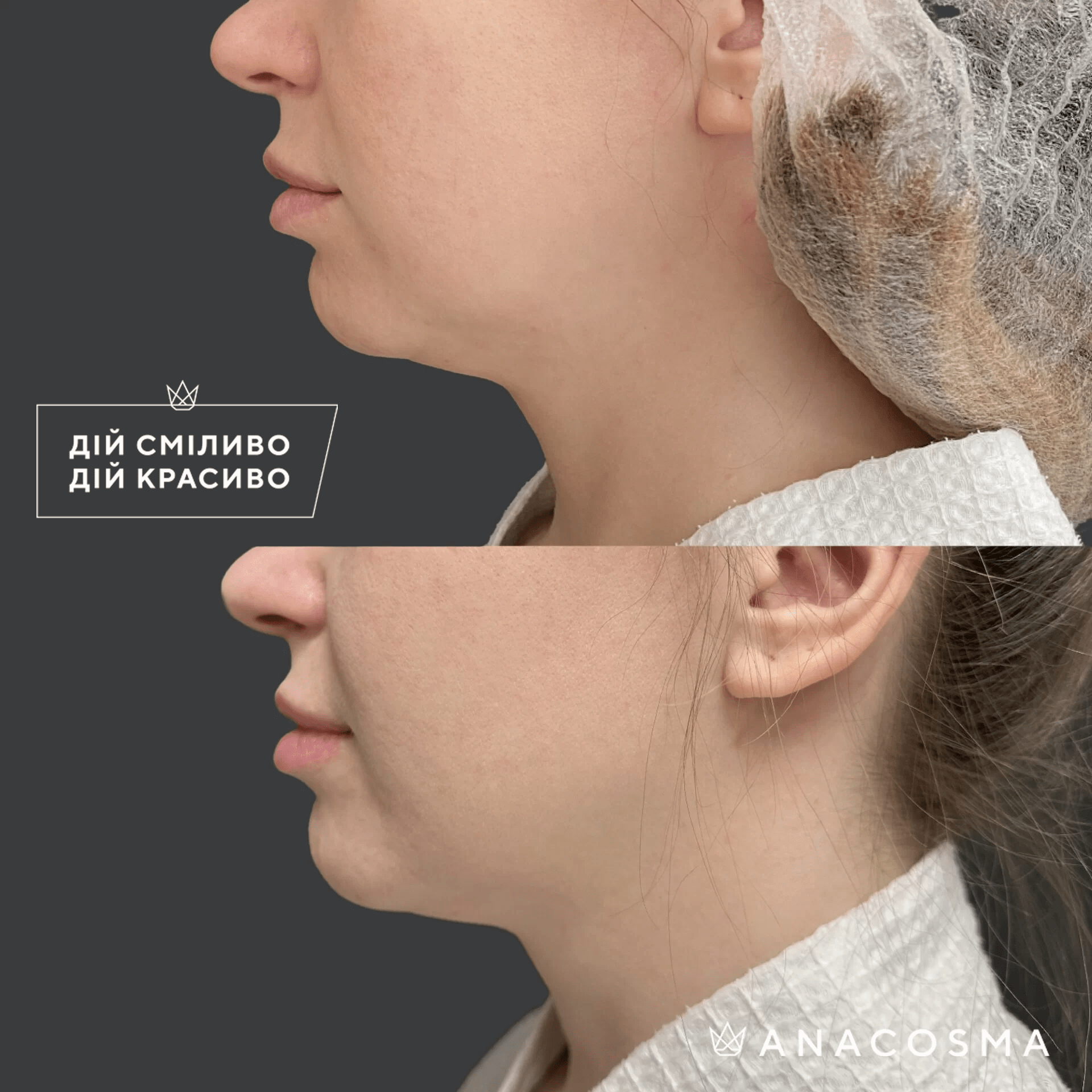 Процедура Agnes RF (монополярний ліфтинг) до і після - Фото 13