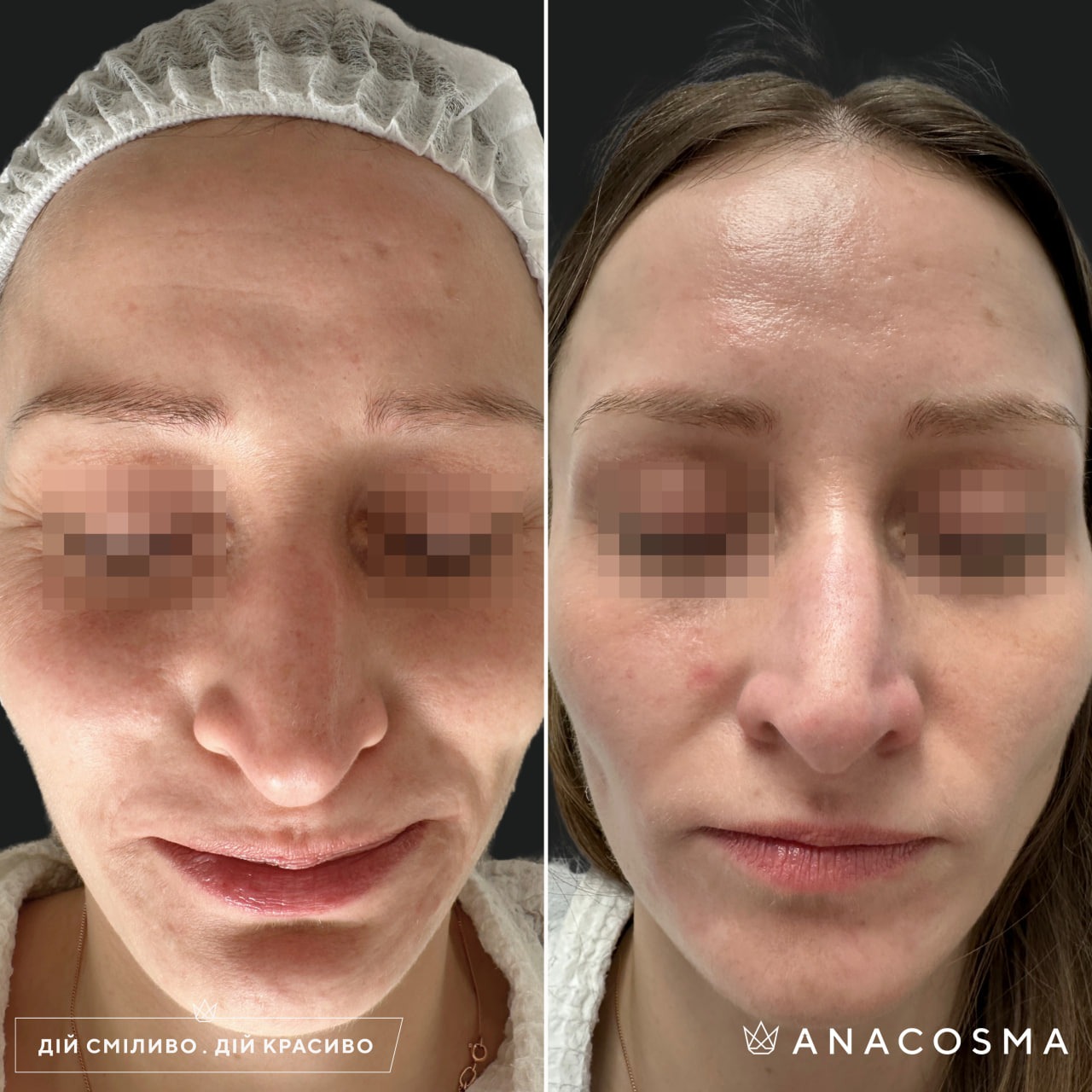 RF-Lift Double Tite before and after - Photo 10