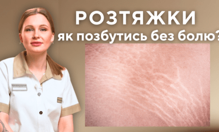Растяжки на теле – как избавиться без боли?