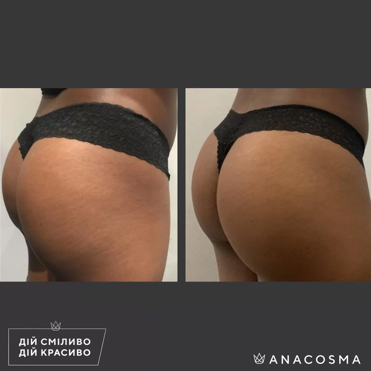Удаление растяжек BI-ONE® до и после - Фото 2