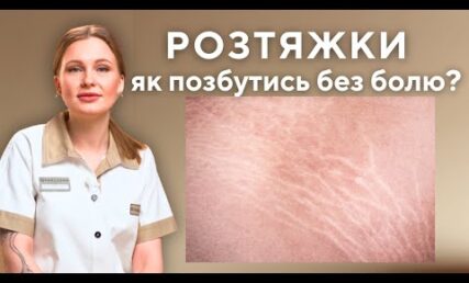 Растяжки на теле – избавиться без боли?