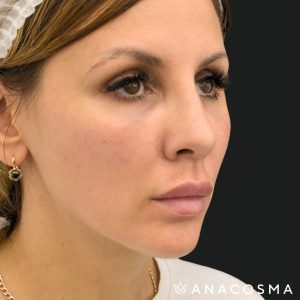 ніс через місяць після ринопластики