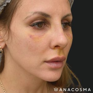 Ринопластика через 7 днів