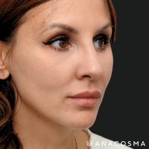 ринопластика через рік